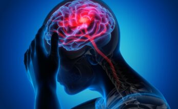 Natural Remedies for Migraine Relief