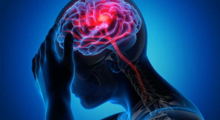 Natural Remedies for Migraine Relief